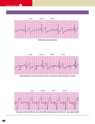 284
A p p e n d i x 3
Lead I Size 1.0 HR=41
Lead I Size 1.0 HR=43 35 mA
Lead I Size 1.0 HR=71 60 mA
Bradycardia: prepacing attempt
Pacing attempted: note pacing stimulus indicator (arrow) which is below threshold; no capture
Pacing above threshold (60 mA): with capture (QRS complex broad and ventricular; T wave opposite QRS)
 