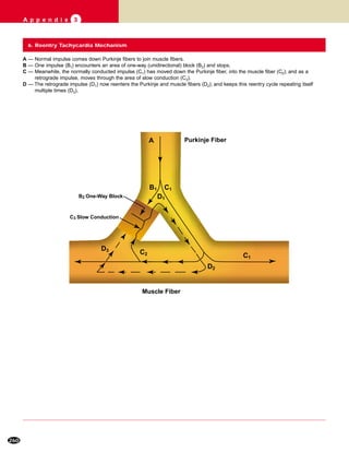 260
A p p e n d i x 3
A
B2 One-Way Block
D2
D3
C3 Slow Conduction
C1
D1
C1B1
C2
Muscle Fiber
Purkinje Fiber
A — Normal impulse comes down Purkinje fibers to join muscle fibers.
B — One impulse (B1) encounters an area of one-way (unidirectional) block (B2) and stops.
C — Meanwhile, the normally conducted impulse (C1) has moved down the Purkinje fiber, into the muscle fiber (C2); and as a
retrograde impulse, moves through the area of slow conduction (C3).
D — The retrograde impulse (D1) now reenters the Purkinje and muscle fibers (D2); and keeps this reentry cycle repeating itself
multiple times (D3).
6. Reentry Tachycardia Mechanism
 