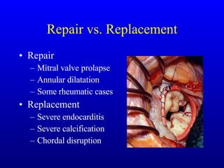 Repair vs. Replacement Repair Mitral valve prolapse Annular dilatation Some rheumatic cases Replacement Severe endocarditis Severe calcification Chordal disruption 