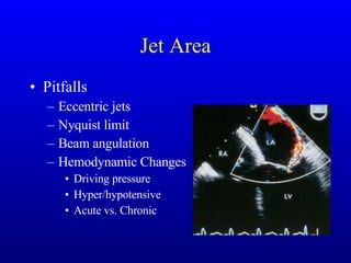 Jet Area Pitfalls Eccentric jets Nyquist limit Beam angulation Hemodynamic Changes Driving pressure Hyper/hypotensive Acute vs. Chronic 