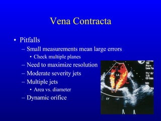 Vena Contracta Pitfalls Small measurements mean large errors Check multiple planes Need to maximize resolution Moderate severity jets Multiple jets Area vs. diameter Dynamic orifice 