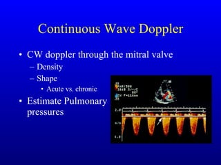 Continuous Wave Doppler CW doppler through the mitral valve Density Shape Acute vs. chronic Estimate Pulmonary pressures 