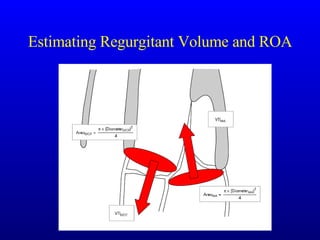 Estimating Regurgitant Volume and ROA 