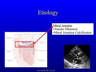 Etiology Mitral Annulus Annular Dilatation Mitral Annuluar Calcification Otto, NEJM, 2001; 345:740 