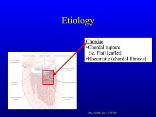 Etiology Chordae Chordal rupture    (ie. Flail leaflet) Rheumatic (chordal fibrosis) Otto, NEJM, 2001; 345:740 