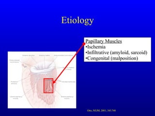 Etiology Papillary Muscles Ischemia Infiltrative (amyloid, sarcoid) Congenital (malposition) Otto, NEJM, 2001; 345:740 