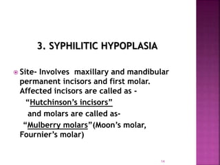 3. SYPHILITIC HYPOPLASIA
 Site- Involves maxillary and mandibular
permanent incisors and first molar.
Affected incisors are called as -
“Hutchinson’s incisors”
and molars are called as-
“Mulberry molars”(Moon’s molar,
Fournier’s molar)
14
 