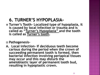 6. TURNER’S HYPOPLASIA-
 Turner’s Tooth- Localized type of hypoplasia, it
is caused by local infection or trauma and is
called as “Turner’s Hypoplasia” and the tooth
is called as Turner’s tooth.
 Pathogenesis-
A. Local infection- If deciduous teeth become
carious during the period when the crown of
succeeding permanent tooth is formed, then
bacterial infection involving periapical tissues
may occur and this may disturb the
ameloblastic layer of permanent tooth bud,
resulting in hypoplastic crown.
20
 