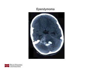 Ependymoma
 