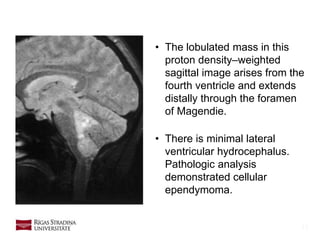 15
• The lobulated mass in this
proton density–weighted
sagittal image arises from the
fourth ventricle and extends
distally through the foramen
of Magendie.
• There is minimal lateral
ventricular hydrocephalus.
Pathologic analysis
demonstrated cellular
ependymoma.
 