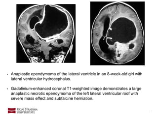 17
• Anaplastic ependymoma of the lateral ventricle in an 8-week-old girl with
lateral ventricular hydrocephalus.
• Gadolinium-enhanced coronal T1-weighted image demonstrates a large
anaplastic necrotic ependymoma of the left lateral ventricular roof with
severe mass effect and subfalcine herniation.
 