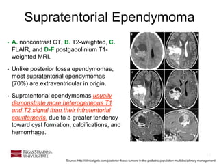 18
Supratentorial Ependymoma
• A. noncontrast CT, B. T2-weighted, C.
FLAIR, and D-F postgadolinium T1-
weighted MRI.
• Unlike posterior fossa ependymomas,
most supratentorial ependymomas
(70%) are extraventricular in origin.
• Supratentorial ependymomas usually
demonstrate more heterogeneous T1
and T2 signal than their infratentorial
counterparts, due to a greater tendency
toward cyst formation, calcifications, and
hemorrhage.
Source: http://clinicalgate.com/posterior-fossa-tumors-in-the-pediatric-population-multidisciplinary-management/
 