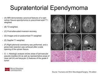 19
Supratentorial Ependymoma
• (A) MRI demonstrates canonical features of a right
sylvian fissure ependymoma on precontrast axial T1-
weighted.
• (B) T2-weighted,
• (C) Fluid-attenuated inversion recovery
• (D) Images and on postcontrast T1-weighted
• (E) Sagittal T1-weighted.
• (F) Right pterional craniotomy was performed, and a
gross total resection was achieved after a wide
opening of the sylvian fissure.
• G - I, Histologic analysis shows areas of perivascular
pseudo-rosettes (G) as well as representative areas of
clear cell (H) and tanycytic (I) features of the grade II
tumor.
Source: Youmans and Winn Neurological Surgery, 7th edition
 