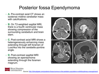 20
Posterior fossa Ependymoma
• A. Pre-contrast axial CT shows an
isodense midline cerebellar mass
with calcifications.
• B. On T2-weighted sagittal MRI,
there is a fourth ventricular mass
showing compression of the
surrounding cerebellum and brain
stem.
• C. Post-contrast axial MRI shows a
heterogeneously enhancing mass
extending through left foramen of
Luschka into the cerebello-pontine
angle.
• D. Post-contrast sagittal MRI
showing an ependymoma
extending through the foramen
magnum.
Source: http://clinicalgate.com/posterior-fossa-tumors-in-the-pediatric-population-multidisciplinary-management/
 