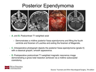 21
Posterior Ependymoma
• A. and B. Postcontrast T1-weighted axial
• Demonstrates a midline posterior fossa ependymoma and filling the fourth
ventricle and foramen of Luschka and exiting the foramen of Magendie.
• C. Intraoperative photograph depicts the posterior fossa ependymoma (grade II)
with a classical grayish, smooth appearance.
• D. Postoperative postcontrast T1-weighted magnetic resonance image
demonstrating a gross total resection achieved via a midline suboccipital
craniotomy.
Source: Youmans and Winn Neurological Surgery, 7th edition
 