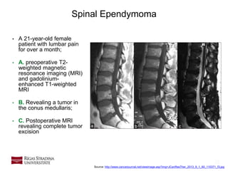 22
Spinal Ependymoma
• A 21-year-old female
patient with lumbar pain
for over a month;
• A. preoperative T2-
weighted magnetic
resonance imaging (MRI)
and gadolinium-
enhanced T1-weighted
MRI
• B. Revealing a tumor in
the conus medullaris;
• C. Postoperative MRI
revealing complete tumor
excision
Source: http://www.cancerjournal.net/viewimage.asp?img=JCanResTher_2013_9_1_60_110371_f3.jpg
 