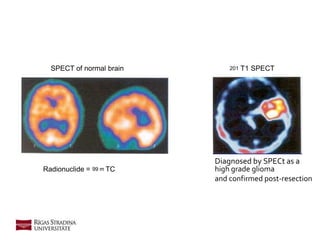 Radionuclide = 99 m TC
SPECT of normal brain 201 T1 SPECT
Diagnosed by SPECt as a
high grade glioma
and confirmed post-resection
 