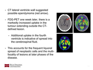 26
• CT lateral ventricle wall suggested
possible ependymoma (red arrow).
• FDG-PET one week later, there is a
markedly increased uptake in the
tumour extending outside the CT-
defined lesion.
• Additional uptake in the fourth
ventricle is indicative of spread into
the cerebrospinal fluid.
• This accounts for the frequent liquoral
spread of neoplastic cells and the multi-
focality of lesions at later phases of the
disease.
 