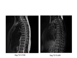 Sag T2 fr FSE Sag T2 FLAIR
 