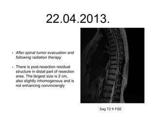 22.04.2013.
• After spinal tumor evacuation and
following radiation therapy
• There is post-resection residual
structure in distal part of resection
area. The largest size is 2 cm,
also slightly inhomogenous and is
not enhancing convinciengly
Sag T2 fr FSE
 