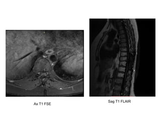 Sag T1 FLAIR
Ax T1 FSE
 