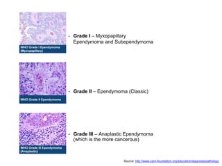 • Grade I – Myxopapillary
Ependymoma and Subependymoma
• Grade II – Ependymoma (Classic)
• Grade III – Anaplastic Ependymoma
(which is the more cancerous)
Source: http://www.cern-foundation.org/education/diagnosis/pathology
 