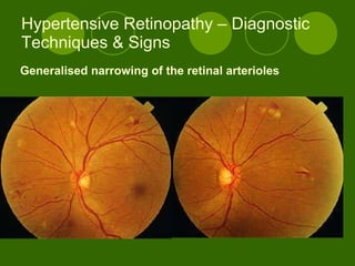 Hypertensive Retinopathy – Diagnostic Techniques & Signs Generalised narrowing of the retinal arterioles 