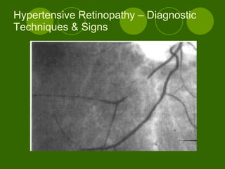 Hypertensive Retinopathy – Diagnostic Techniques & Signs 