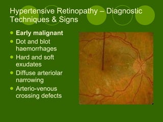 Hypertensive Retinopathy – Diagnostic Techniques & Signs Early malignant Dot and blot haemorrhages Hard and soft exudates Diffuse arteriolar narrowing Arterio-venous crossing defects 