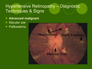 Hypertensive Retinopathy – Diagnostic Techniques & Signs Advanced malignant Macular star Pailloedema 