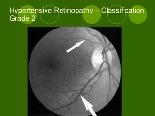 Hypertensive Retinopathy – Classification Grade 2 