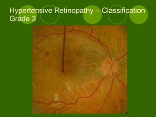 Hypertensive Retinopathy – Classification Grade 3 