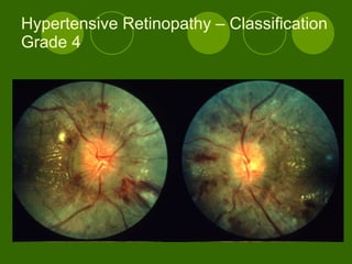 Hypertensive Retinopathy – Classification Grade 4 