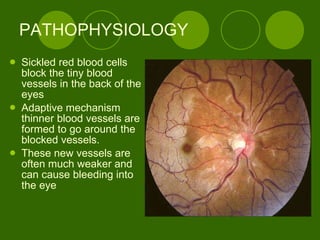 PATHOPHYSIOLOGY Sickled red blood cells block the tiny blood vessels in the back of the eyes  Adaptive mechanism thinner blood vessels are formed to go around the blocked vessels. These new vessels are often much weaker and can cause bleeding into the eye  