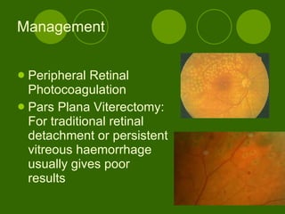 Management Peripheral Retinal Photocoagulation Pars Plana Viterectomy: For traditional retinal detachment or persistent vitreous haemorrhage usually gives poor results 