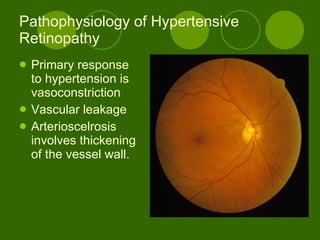 Pathophysiology of Hypertensive Retinopathy Primary response to hypertension is vasoconstriction Vascular leakage Arterioscelrosis involves thickening of the vessel wall. 