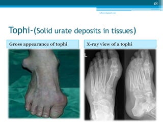 Tophi-(Solid urate deposits in tissues) 
Gross appearance of tophi X-ray view of a tophi 
18 
sriloy21@gmail.com 
 