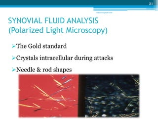 SYNOVIAL FLUID ANALYSIS 
(Polarized Light Microscopy) 
The Gold standard 
Crystals intracellular during attacks 
Needle & rod shapes 
21 
sriloy21@gmail.com 
 