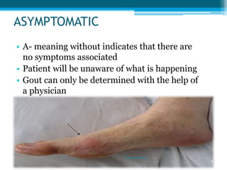 ASYMPTOMATIC 
• A- meaning without indicates that there are 
no symptoms associated 
• Patient will be unaware of what is happening 
• Gout can only be determined with the help of 
a physician 
7 
sriloy21@gmail.com 
 