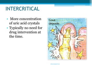 INTERCRITICAL 
• More concentration 
of uric acid crystals 
• Typically no need for 
drug intervention at 
the time. 
9 
sriloy21@gmail.com 
 