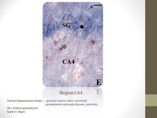 Region CA4
Human hippocampus shows: - granular neuron (blue, diamond)
                          - protoplasmic astrocyte (brown, asteristic)
SG= stratum granulosum
Scale E= 20µm
 