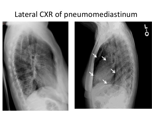 Hypertransradiant hemithorax