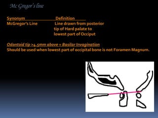 Mc Gregor’s line
Synonym
McGregor’s Line

Definition
Line drawn from posterior
tip of Hard palate to
lowest part of Occiput

Odontoid tip >4.5mm above = Basilar Invagination
Should be used when lowest part of occipital bone is not Foramen Magnum.

 