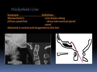 Wackenheim’s Line
Synonym
Wackenheim's
(Clivus canal) line

Definition
Line drawn along
clivus into cervical spinal
canal
Odontoid is ventral and tangential to this line

 