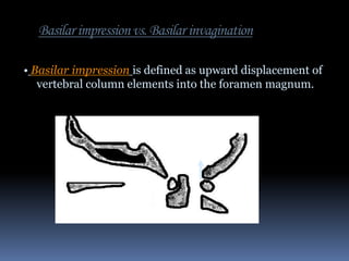 Basilar impression vs. Basilar invagination
• Basilar impression is defined as upward displacement of
vertebral column elements into the foramen magnum.

 