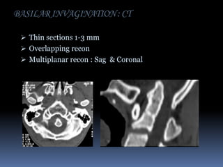 BASILAR INVAGINATION : CT
 Thin sections 1-3 mm
 Overlapping recon

 Multiplanar recon : Sag & Coronal

 