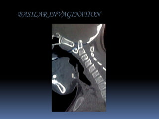 BASILAR INVAGINATION

 