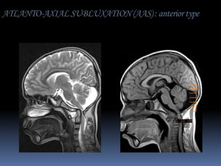 ATLANTO-AXIAL SUBLUXATION (AAS) : anterior type

 