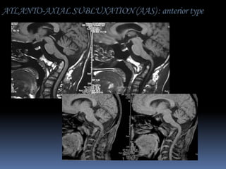 ATLANTO-AXIAL SUBLUXATION (AAS) : anterior type

 