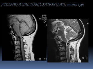 ATLANTO-AXIAL SUBLUXATION (AAS) : anterior type

 